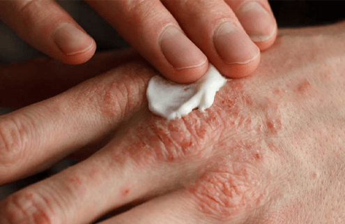 Egzama (Atopik dermatit) nedir?
